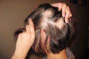 Read more about the article Alopecia areata x Fatores emocionais: conheça os sintomas, causas e tratamento