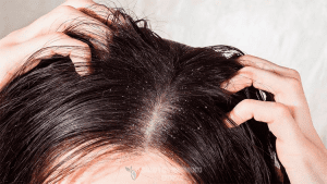 Leia mais sobre o artigo Lavar o cabelo todos os dias ajuda a prevenir a caspa?