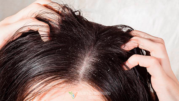 Lavar o cabelo todos os dias ajuda a prevenir a caspa? - Clínica Optimize