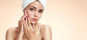 Leia mais sobre o artigo Acne tem tratamento?