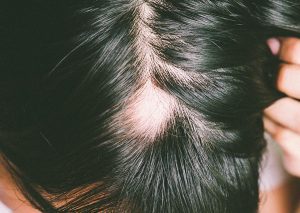 Leia mais sobre o artigo Alopecia Areata: doença inflamatória que provoca a queda de cabelo