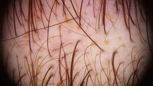 Leia mais sobre o artigo Alopecia Androgenética –  Entrevista realizada pela Rádio CBN