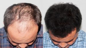 Leia mais sobre o artigo O que é o minoxidil? Conheça o medicamento e suas contraindicações