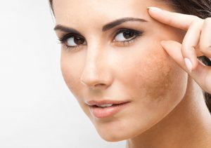 Leia mais sobre o artigo As manchas do melasma: como tratar e prevenir?